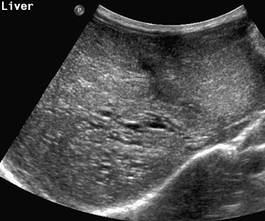 Autosomal Recessive Polycystic Kidney Disease Ultrasound