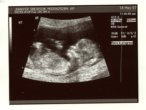 Baby At 12 Weeks Pregnant Pictures