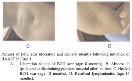 Bcg Injection Site Infection