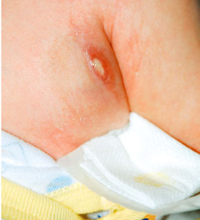 Bcg Vaccine Abscess Management