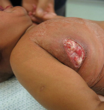 Bcg Vaccine Reaction Newborn