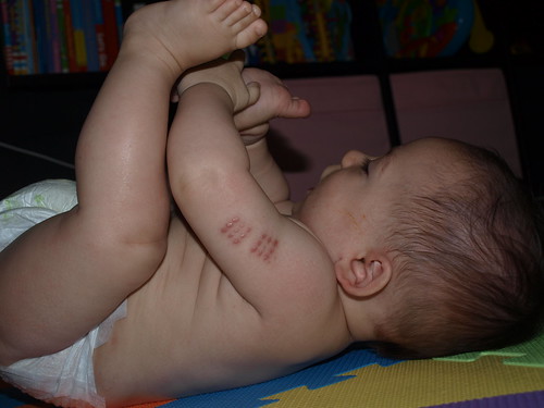 Bcg Vaccine Reaction On Baby