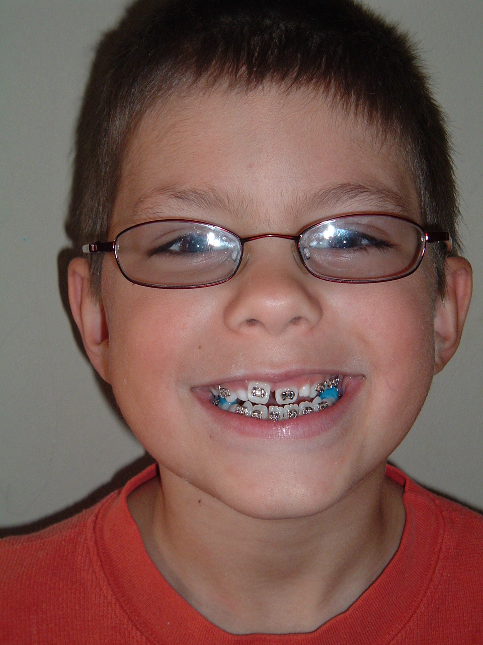 Blue Braces For Teeth