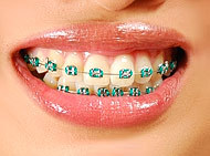 Blue Braces For Teeth