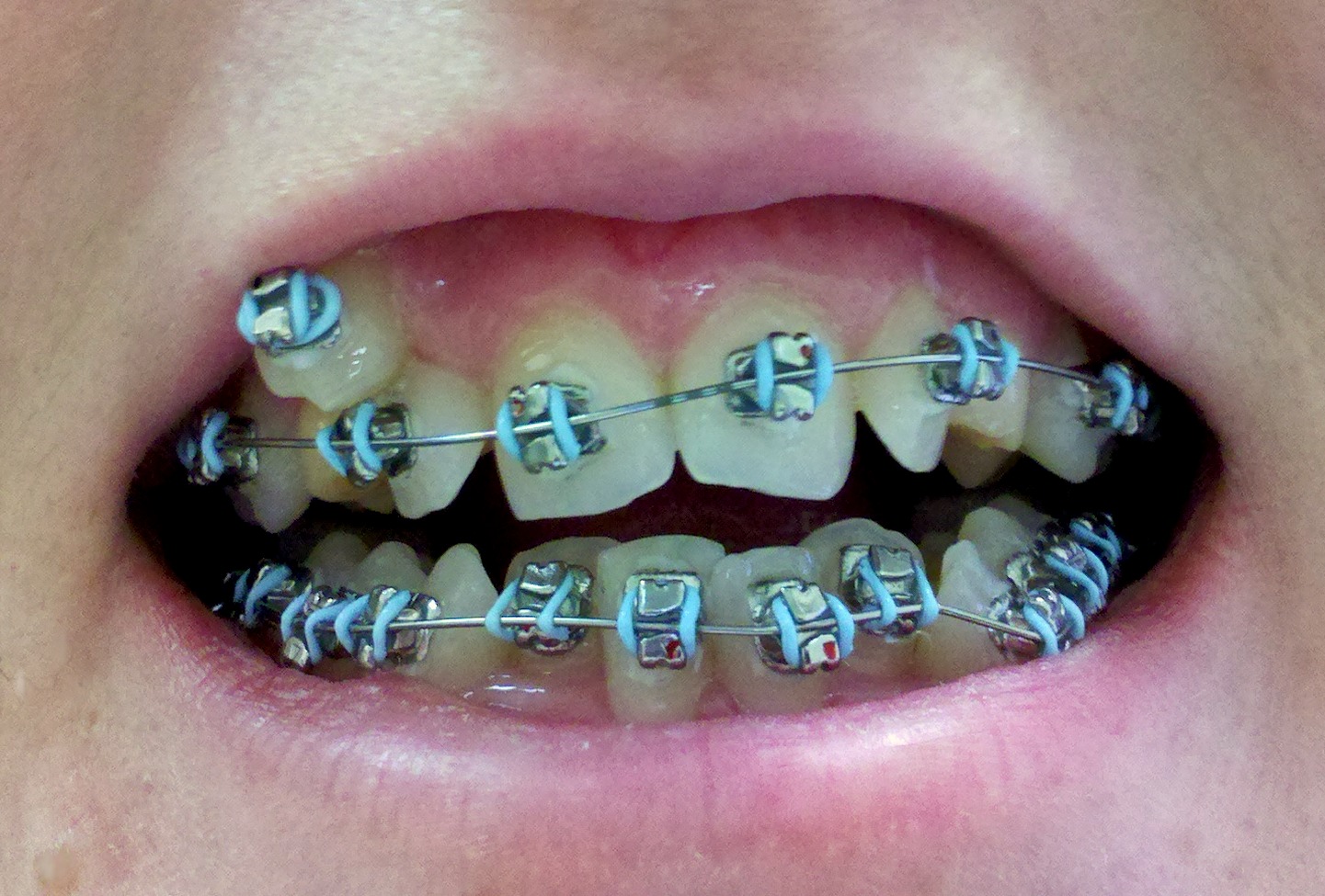 Blue Braces For Teeth