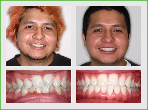 Braces Before And After Gap