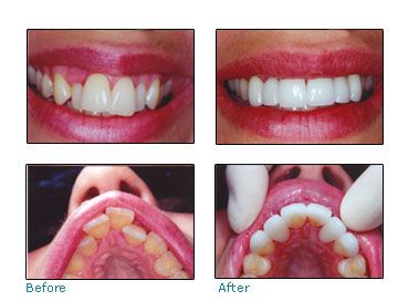 Braces Before And After Gap