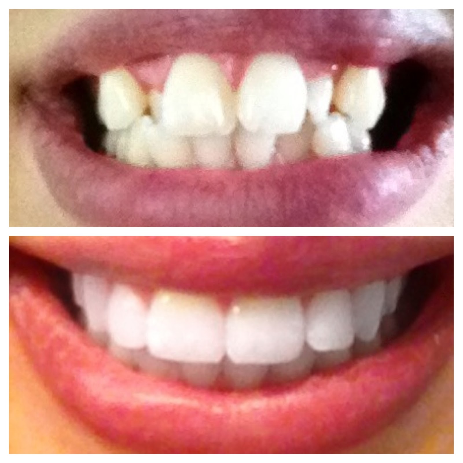 Braces Before And After Pics