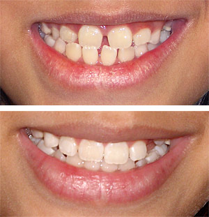 Braces Before And After Pics