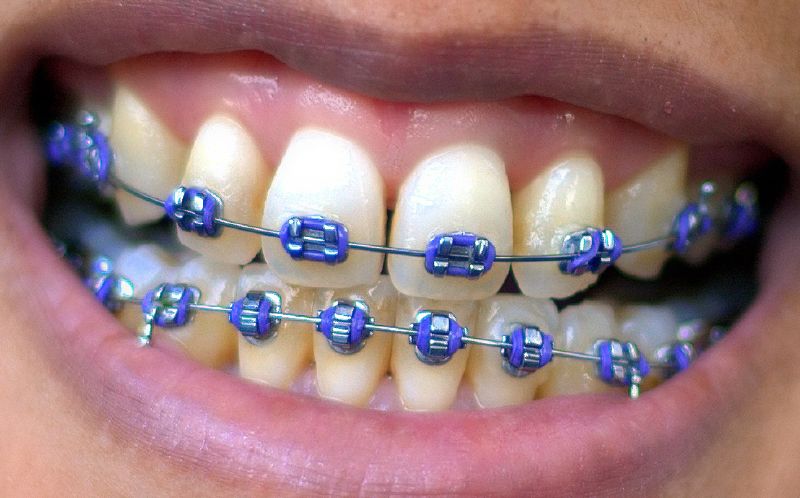 Braces Colors Black