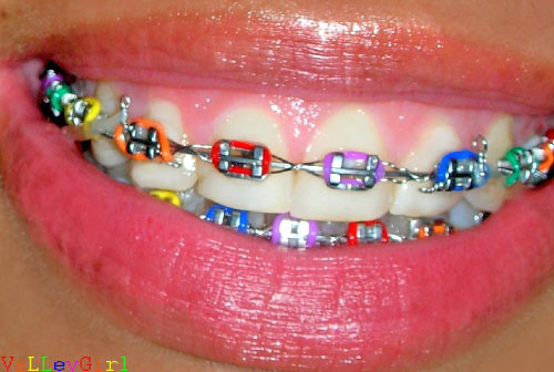 Braces Colors Combinations