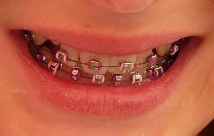 Braces Colors Combinations