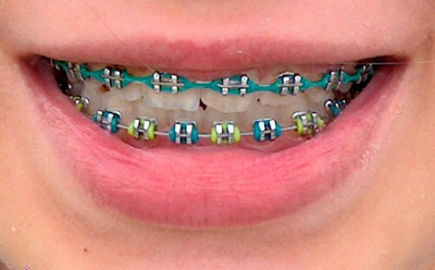 Braces Colors For Girls