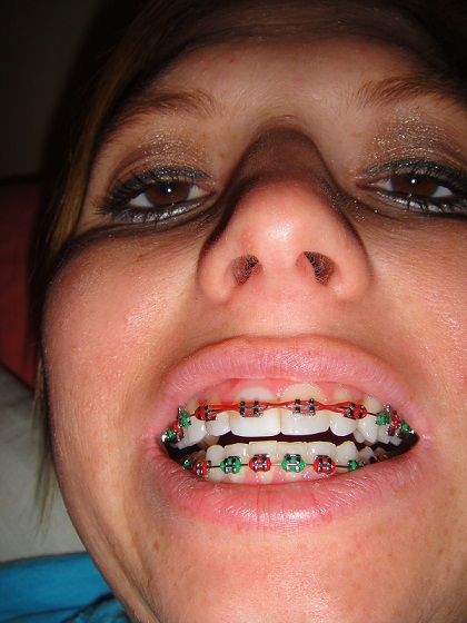 Braces Colors For Girls