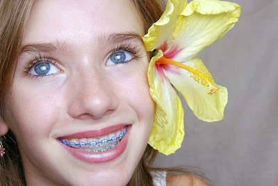 Braces Colors For Girls