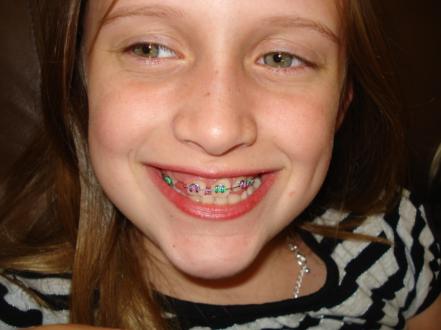 Braces Colors For Girls