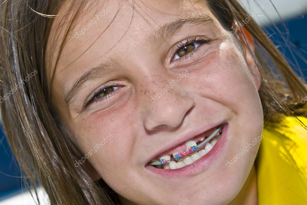 Braces Colors For Girls Teeth