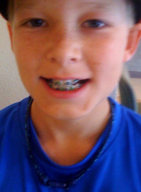 Braces Colors For Guys