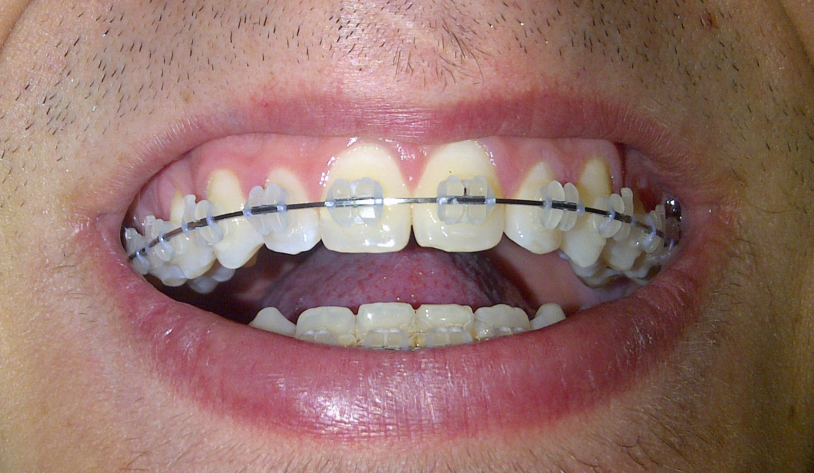 Braces Colors For Guys