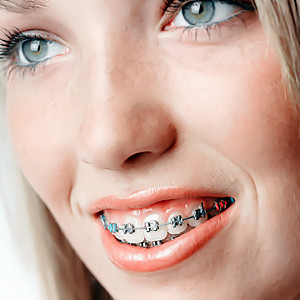 Braces Colors For Guys