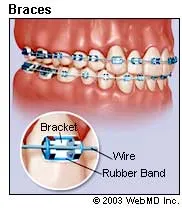 Braces Colors For Guys