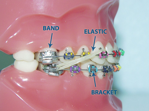 Braces Colors For Guys