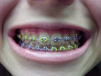 Braces Colors Ideas