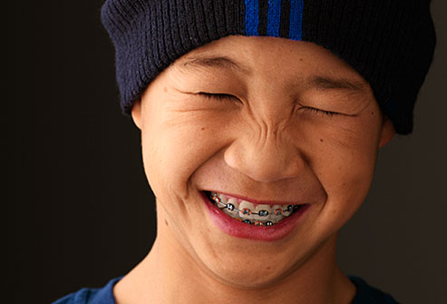 Braces Colors Ideas