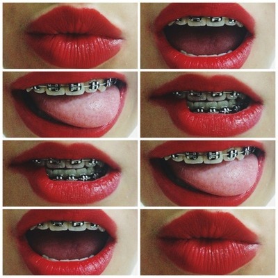 Braces Colors Tumblr