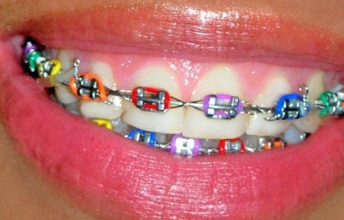 Braces Colors Tumblr