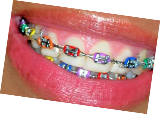 Braces Colours For Boys