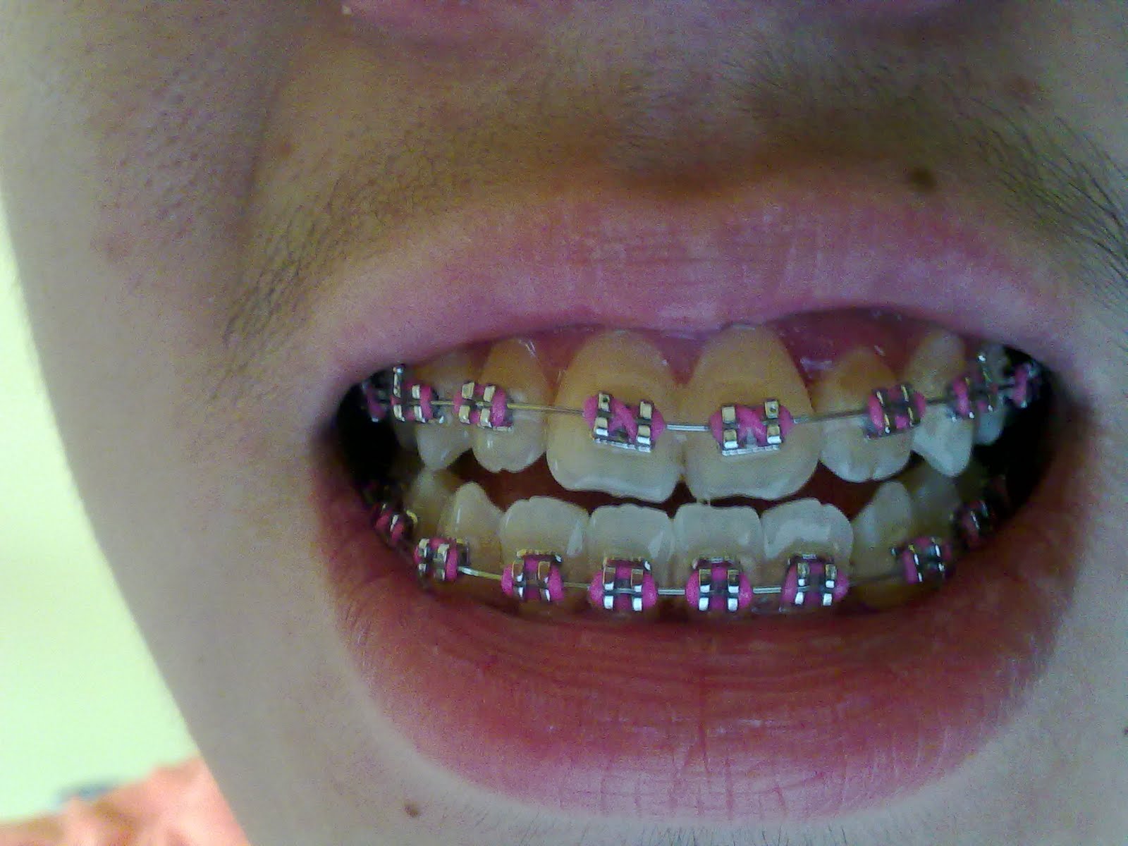 Braces Colours For Boys