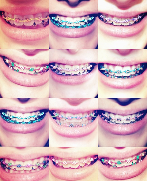 Braces Colours For Boys