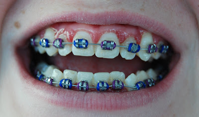 Braces Colours For Girls