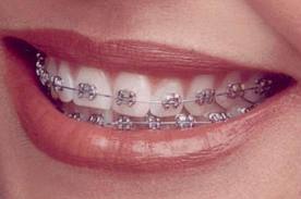 Braces Cost