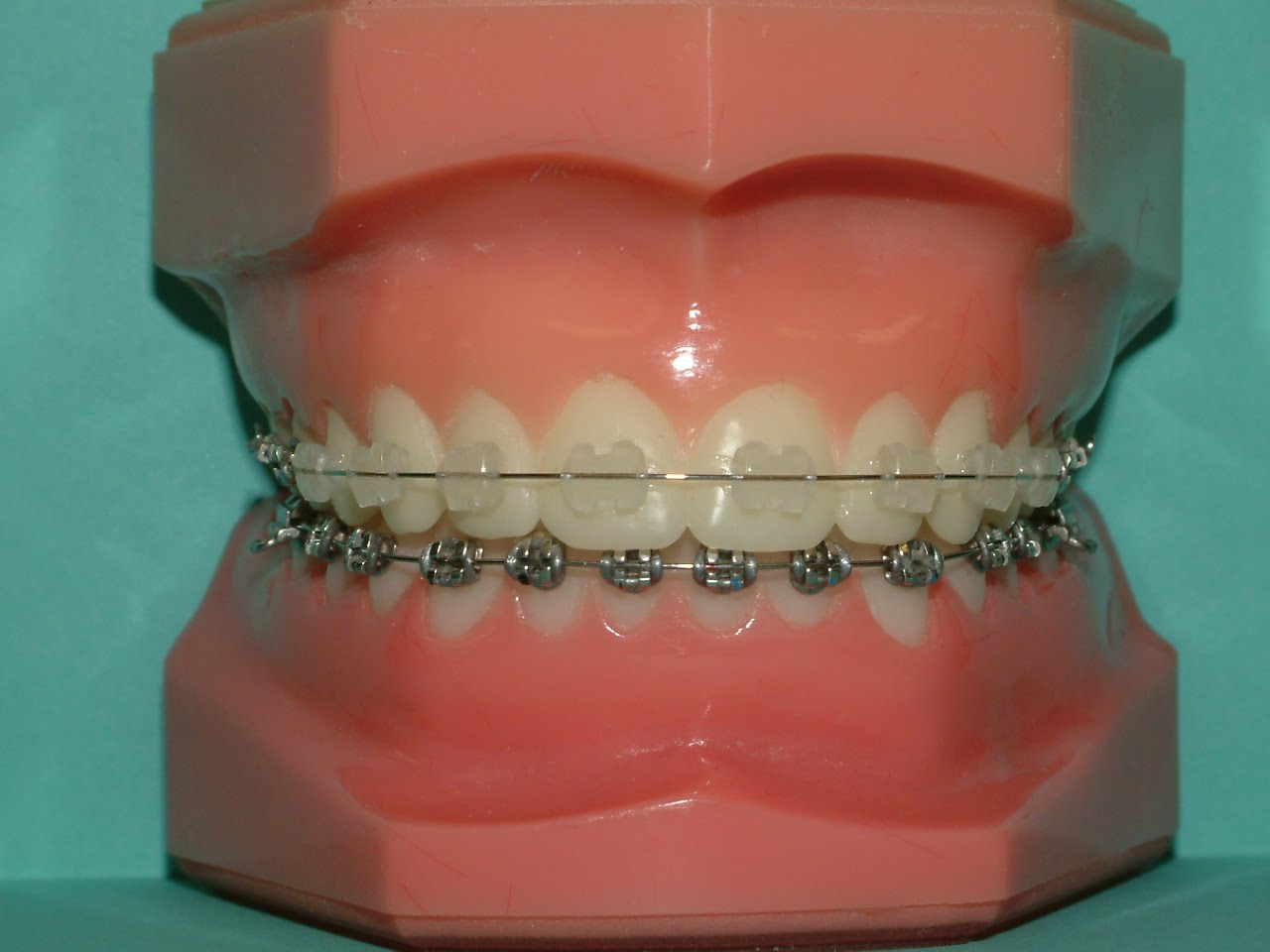 Braces Cost