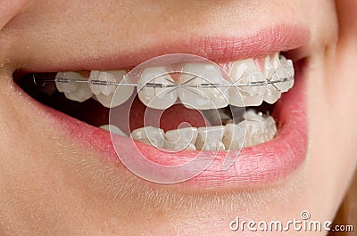 Braces For Teeth