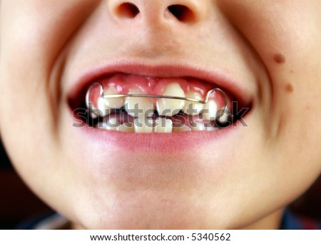 Braces For Teeth