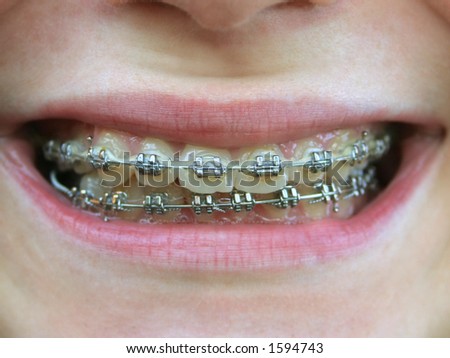 Braces For Teeth