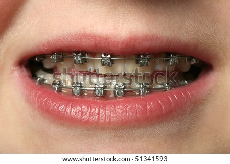 Braces For Teeth