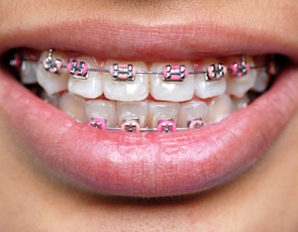 Braces For Teeth Colors