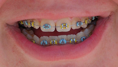 Braces For Teeth Colors