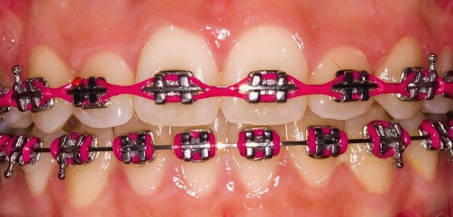 Braces For Teeth Colours