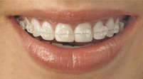 Braces For Teeth Colours