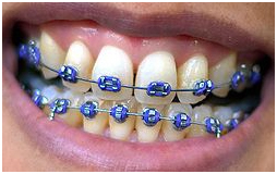 Braces For Teeth Cost