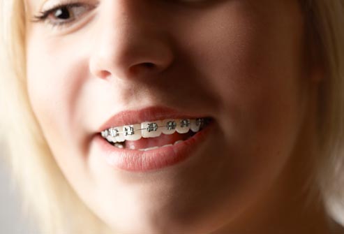 Braces For Teeth Cost