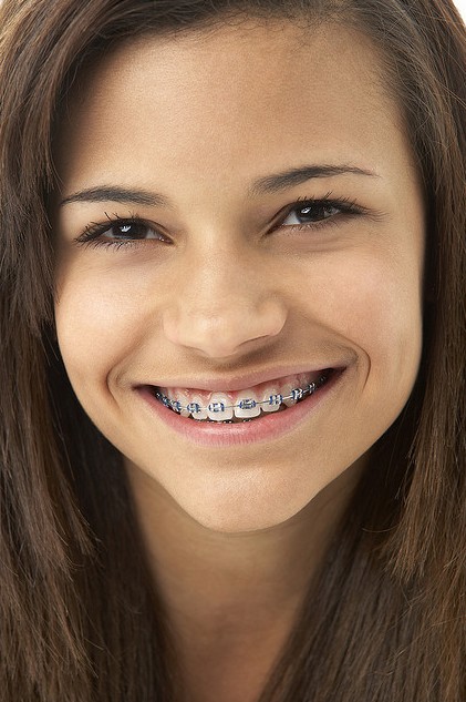 Braces For Teeth Design