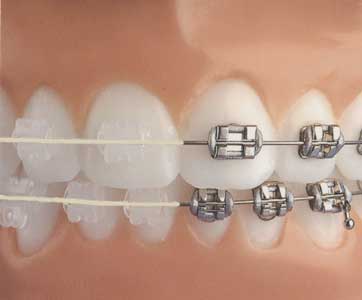 Braces Prices