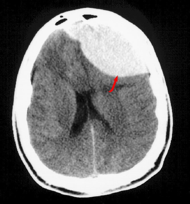 Brain Anatomy Ct Scan