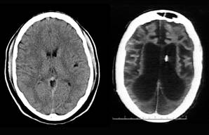 Brain Anatomy Ct Scan